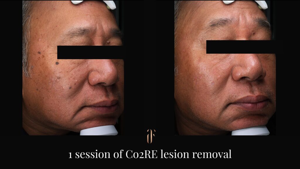 co2 lesion removal
