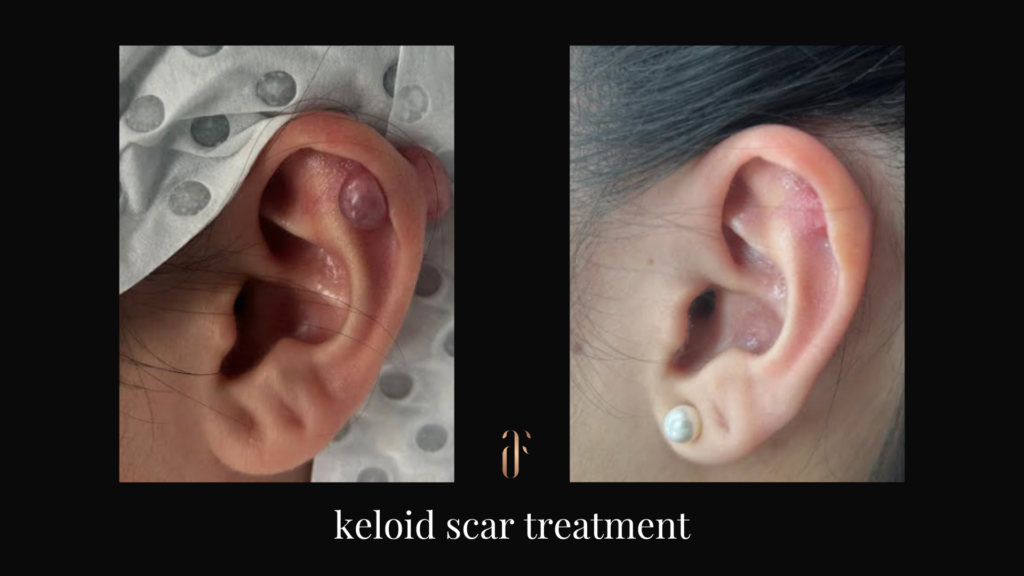 keloid scar removal sydney