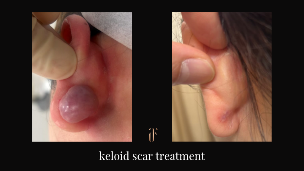 keloid scar before and after