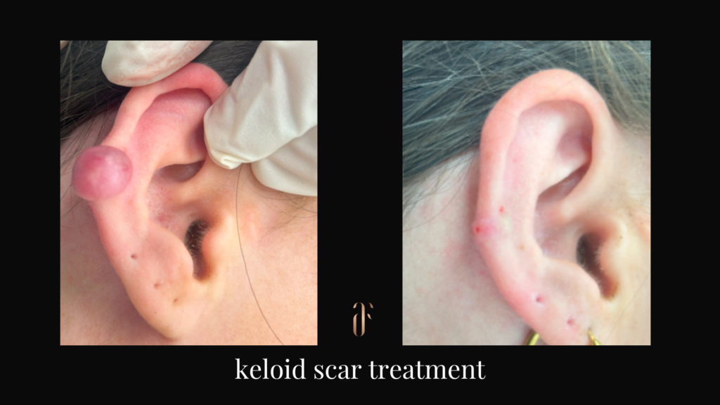 keloid scar treatment before and after
