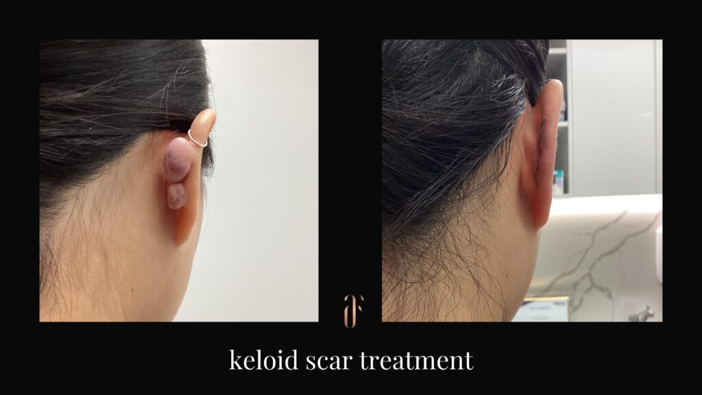 keloid scar treatment before and after