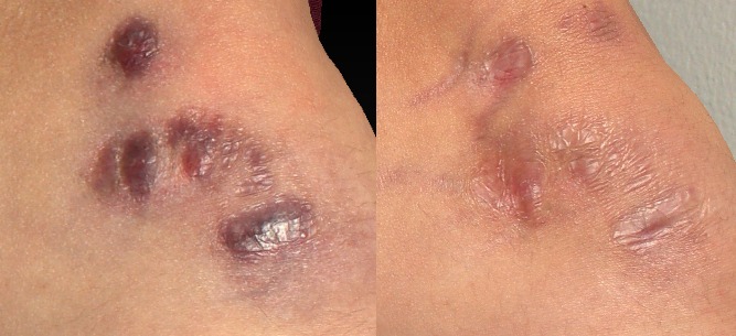 keloid scar before and after