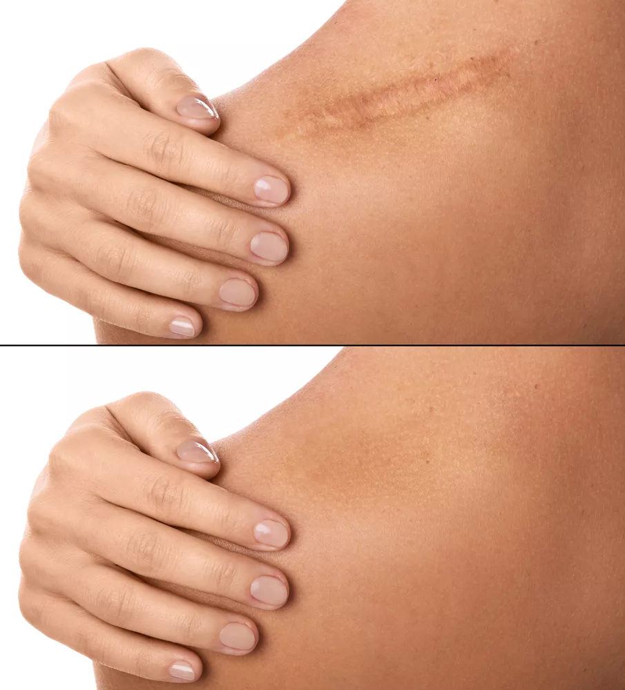 scar treatment before and after